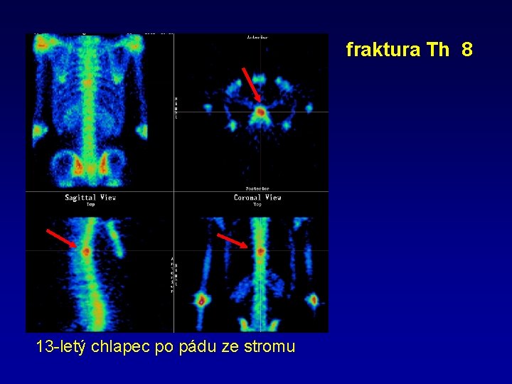 fraktura Th 8 13 -letý chlapec po pádu ze stromu 