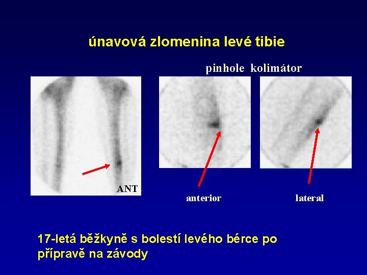 únavová zlomenina levé tibie pinhole kolimátor ANT anterior 17 -letá běžkyně s bolestí levého