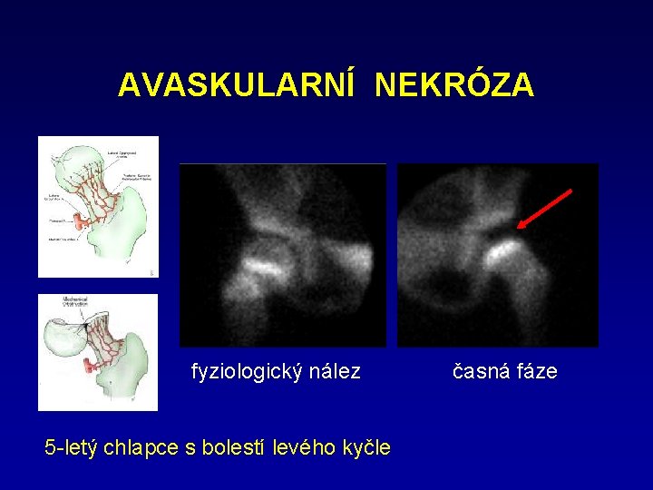 AVASKULARNÍ NEKRÓZA fyziologický nález 5 -letý chlapce s bolestí levého kyčle časná fáze 