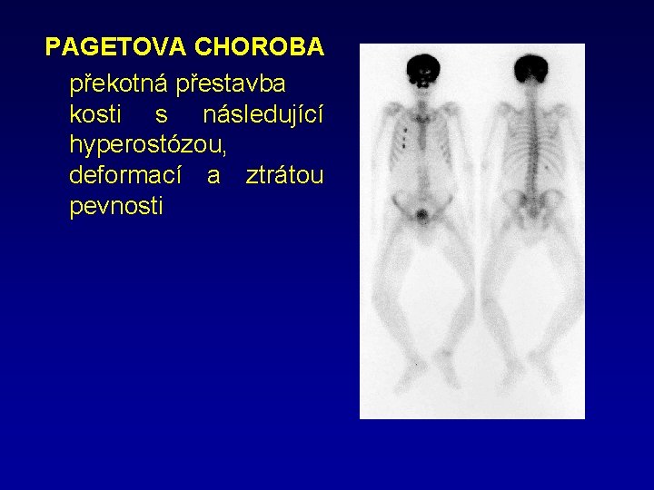 PAGETOVA CHOROBA překotná přestavba kosti s následující hyperostózou, deformací a ztrátou pevnosti 