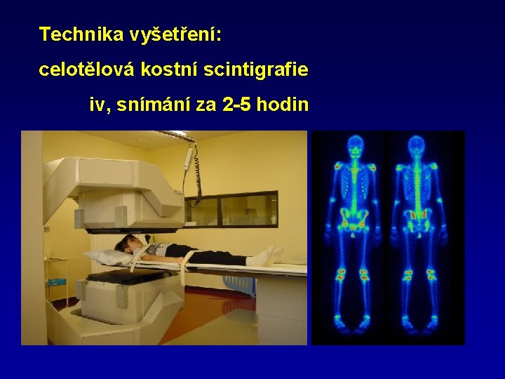 Technika vyšetření: celotělová kostní scintigrafie iv, snímání za 2 -5 hodin 