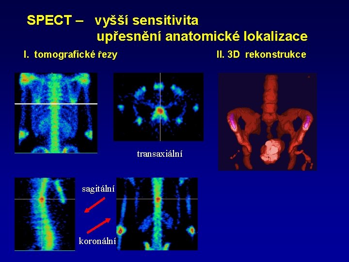 SPECT – vyšší sensitivita upřesnění anatomické lokalizace I. tomografické řezy II. 3 D rekonstrukce