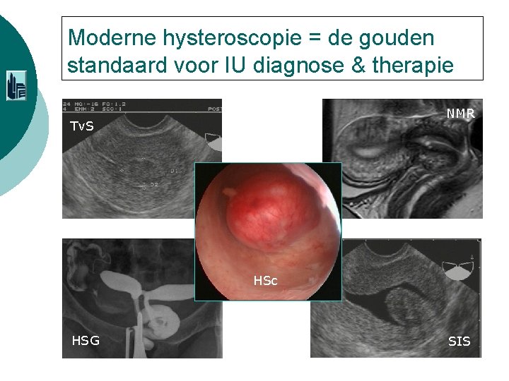 Moderne hysteroscopie = de gouden standaard voor IU diagnose & therapie NMR Tv. S