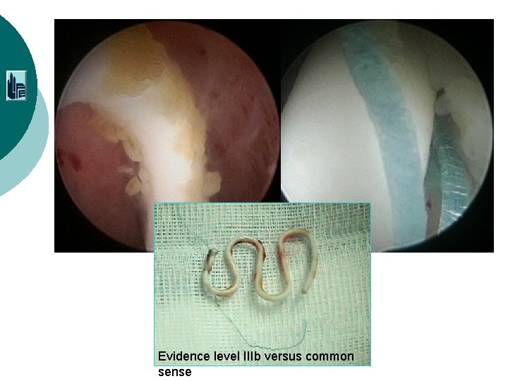 Evidence level IIIb versus common sense 