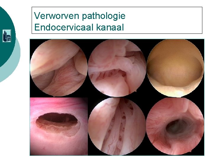 Verworven pathologie Endocervicaal kanaal 