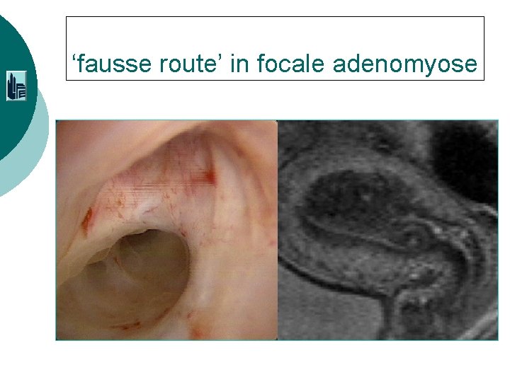 ‘fausse route’ in focale adenomyose 