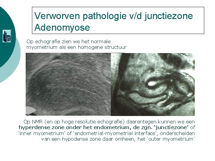 Verworven pathologie v/d junctiezone Adenomyose Op echografie zien we het normale myometrium als een