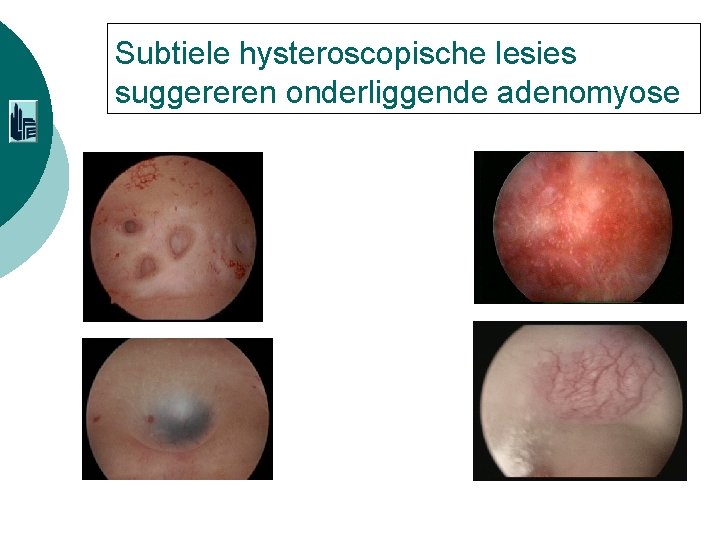 Subtiele hysteroscopische lesies suggereren onderliggende adenomyose 