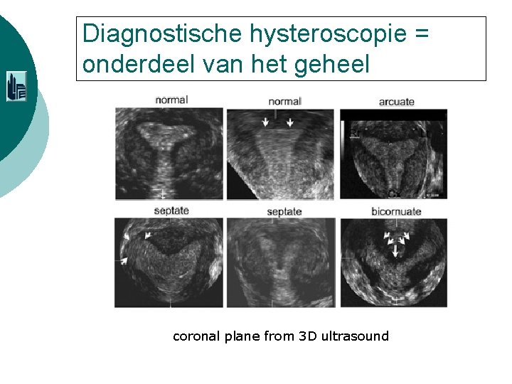 Diagnostische hysteroscopie = onderdeel van het geheel coronal plane from 3 D ultrasound 