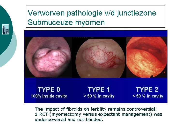 Verworven pathologie v/d junctiezone Submuceuze myomen The impact of fibroids on fertility remains controversial;