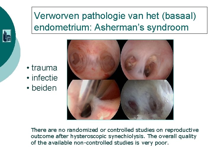 Verworven pathologie van het (basaal) endometrium: Asherman’s syndroom • trauma • infectie • beiden