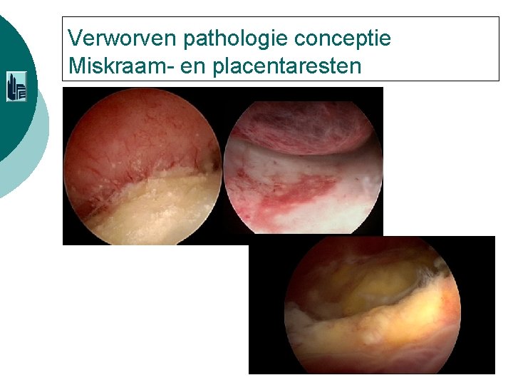 Verworven pathologie conceptie Miskraam- en placentaresten 