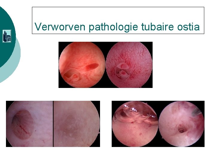 Verworven pathologie tubaire ostia 