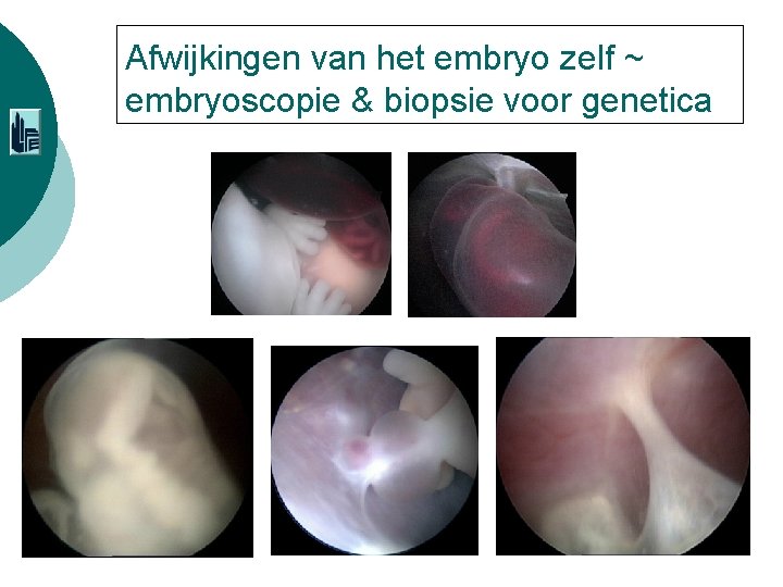 Afwijkingen van het embryo zelf ~ embryoscopie & biopsie voor genetica 