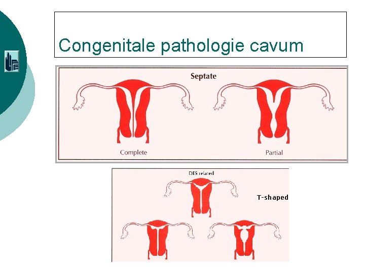 Congenitale pathologie cavum T-shaped 