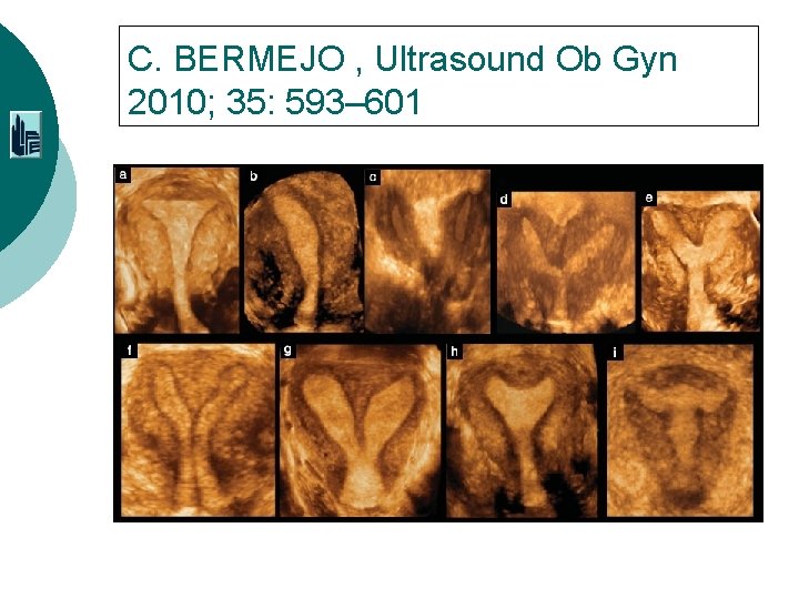 C. BERMEJO , Ultrasound Ob Gyn 2010; 35: 593– 601 