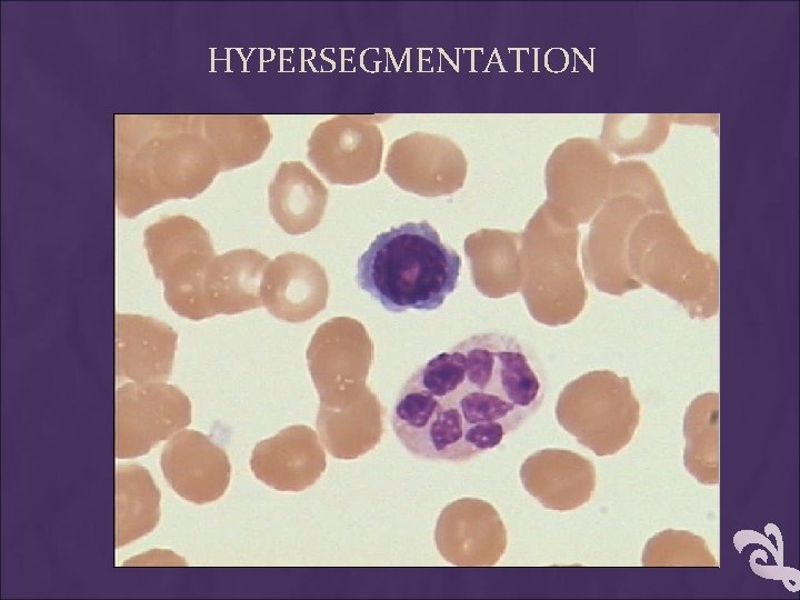 HYPERSEGMENTATION 