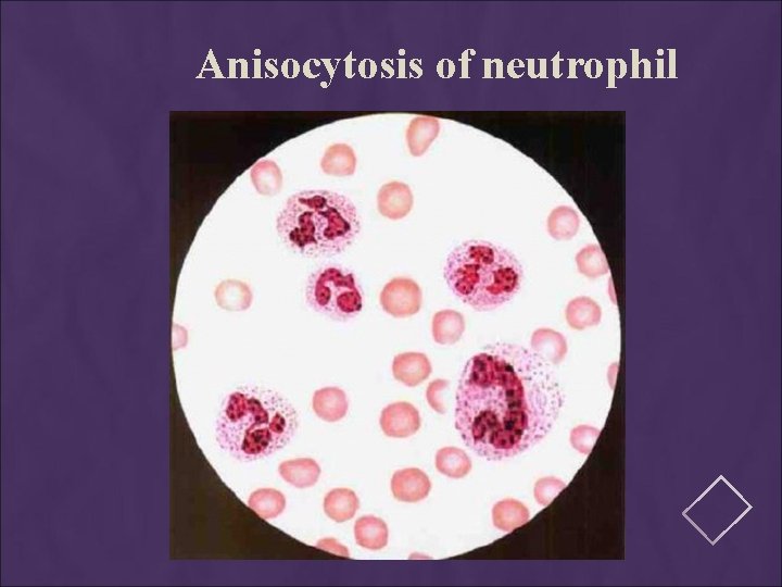 Anisocytosis of neutrophil 