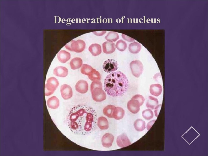 Degeneration of nucleus 
