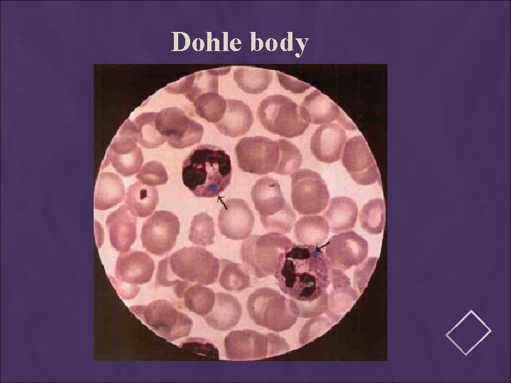 Dohle body 