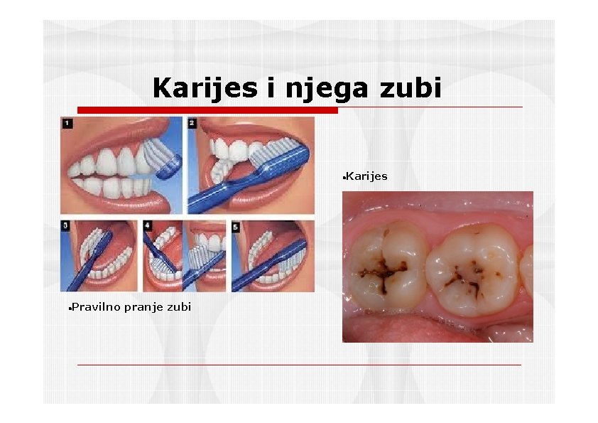 Karijes i njega zubi Karijes Pravilno pranje zubi 