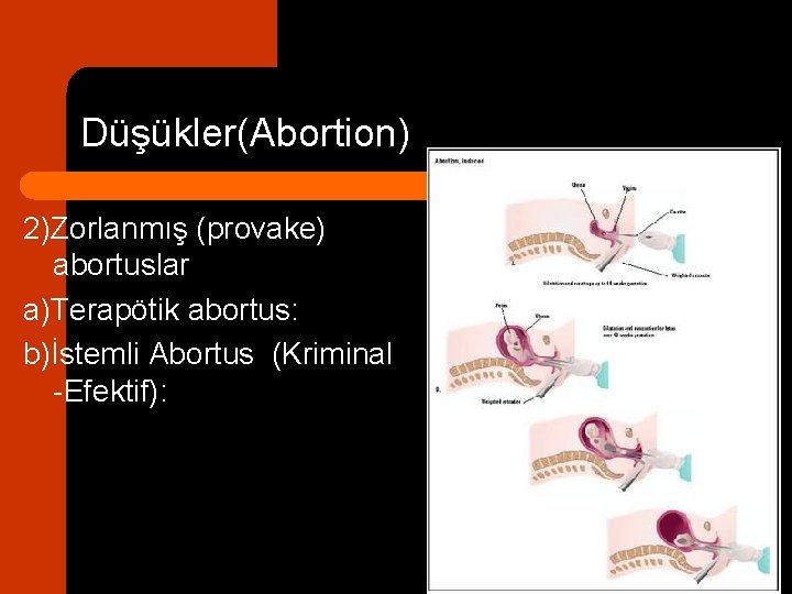 Düşükler(Abortion) 2)Zorlanmış (provake) abortuslar a)Terapötik abortus: b)İstemli Abortus (Kriminal -Efektif): 