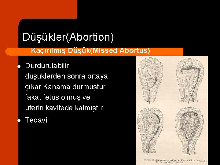 Düşükler(Abortion) Kaçırılmış Düşük(Missed Abortus) l Durdurulabilir düşüklerden sonra ortaya çıkar. Kanama durmuştur fakat fetüs