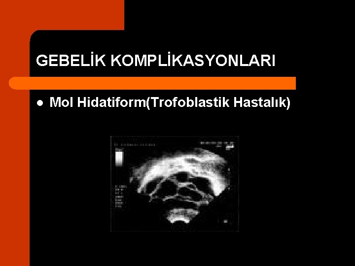 GEBELİK KOMPLİKASYONLARI l Mol Hidatiform(Trofoblastik Hastalık) 