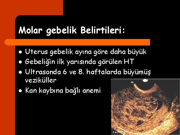 Molar gebelik Belirtileri: l l Uterus gebelik ayına göre daha büyük Gebeliğin ilk yarısında