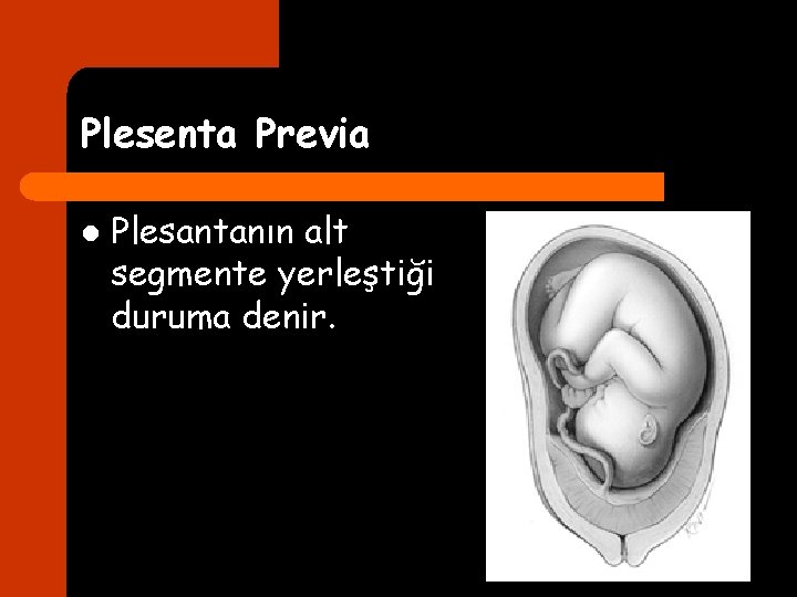 Plesenta Previa l Plesantanın alt segmente yerleştiği duruma denir. 