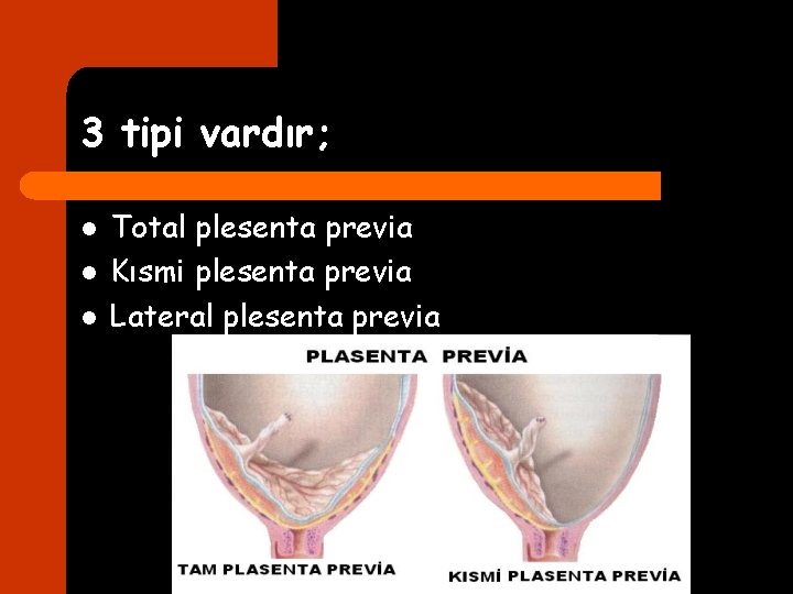 3 tipi vardır; l l l Total plesenta previa Kısmi plesenta previa Lateral plesenta
