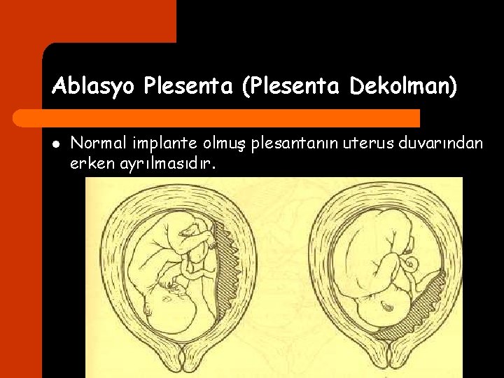 Ablasyo Plesenta (Plesenta Dekolman) l Normal implante olmuş plesantanın uterus duvarından erken ayrılmasıdır. 