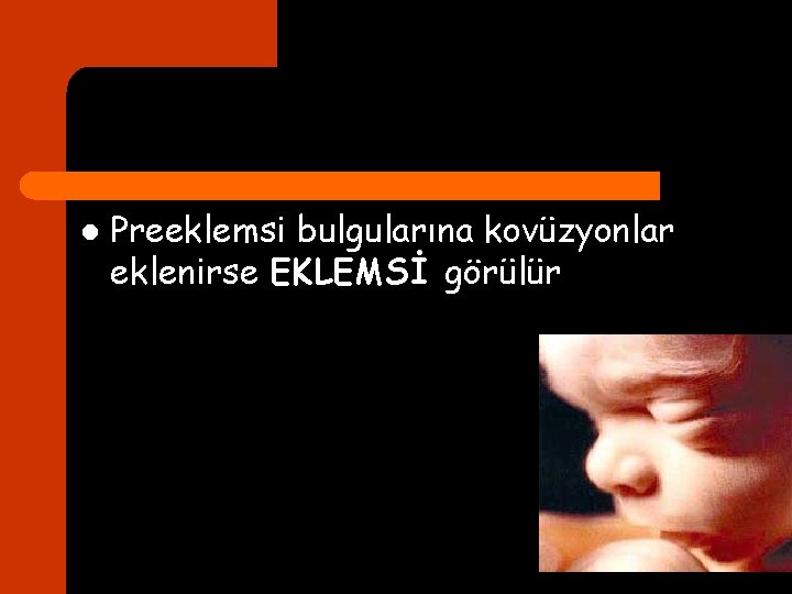 l Preeklemsi bulgularına kovüzyonlar eklenirse EKLEMSİ görülür 