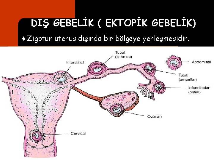 DIŞ GEBELİK ( EKTOPİK GEBELİK) ♦ Zigotun uterus dışında bir bölgeye yerleşmesidir. 