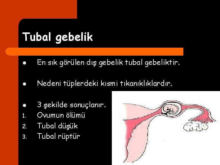 Tubal gebelik l En sık görülen dış gebelik tubal gebeliktir. l Nedeni tüplerdeki kısmi