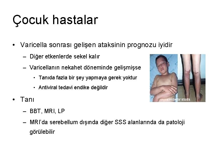 Çocuk hastalar • Varicella sonrası gelişen ataksinin prognozu iyidir – Diğer etkenlerde sekel kalır