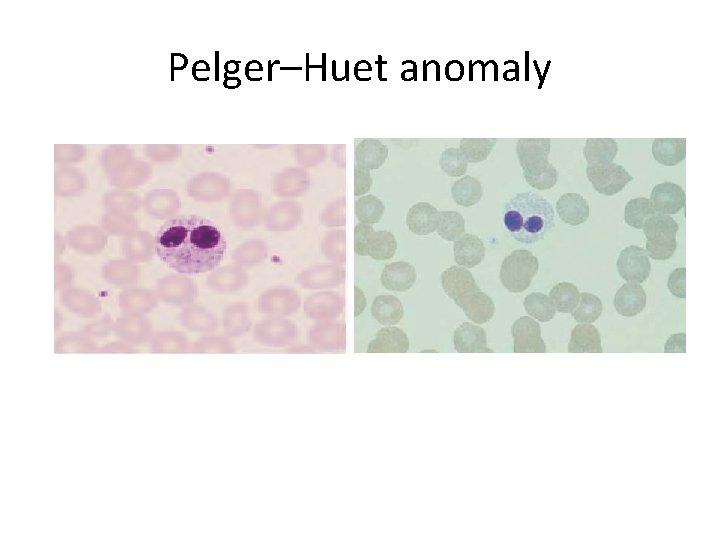 Pelger–Huet anomaly 