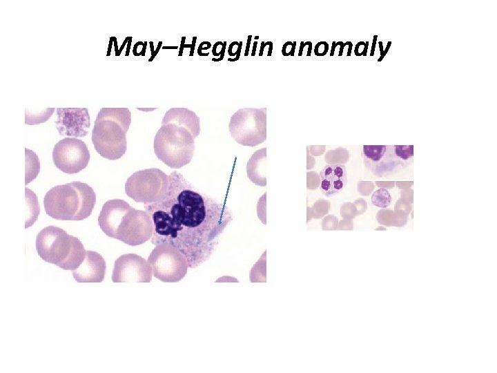 May–Hegglin anomaly 