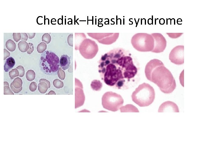 Chediak–Higashi syndrome 