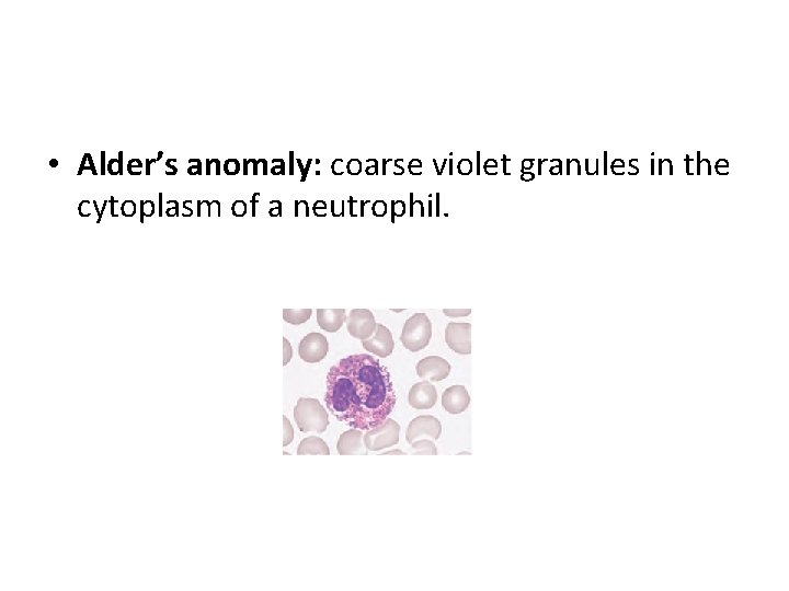  • Alder’s anomaly: coarse violet granules in the cytoplasm of a neutrophil. 