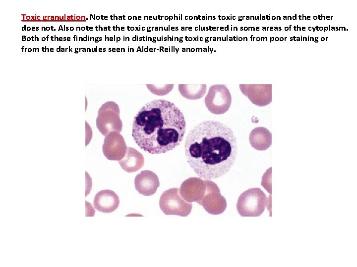 Toxic granulation Note that one neutrophil contains toxic granulation and the other does not.