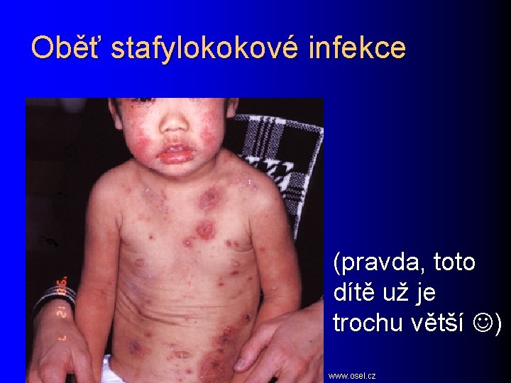 Oběť stafylokokové infekce (pravda, toto dítě už je trochu větší ) www. osel. cz