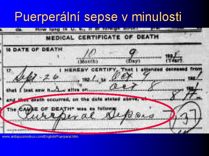 Puerperální sepse v minulosti www. antiquusmorbus. com/English/Puerperal. htm 