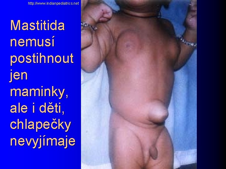  http: //www. indianpediatrics. net Mastitida nemusí postihnout jen maminky, ale i děti, chlapečky