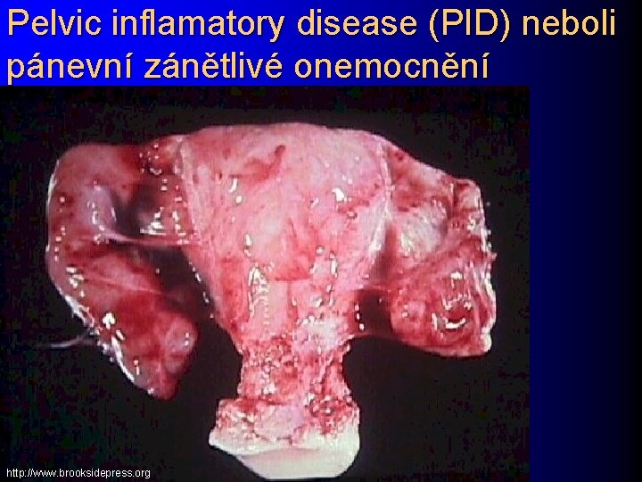 Pelvic inflamatory disease (PID) neboli pánevní zánětlivé onemocnění http: //www. brooksidepress. org 