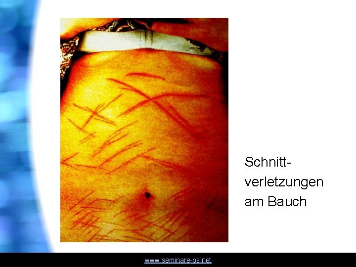 Schnittverletzungen am Bauch www. seminare-ps. net 
