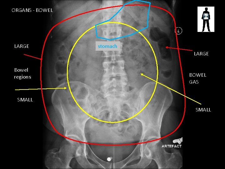 ORGANS - BOWEL LARGE stomach LARGE Bowel regions BOWEL GAS SMALL 