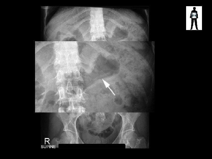 Normal Stomach Pattern 