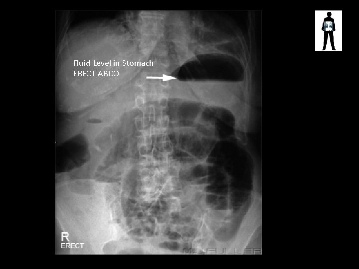 Fluid Level in Stomach ERECT ABDO 