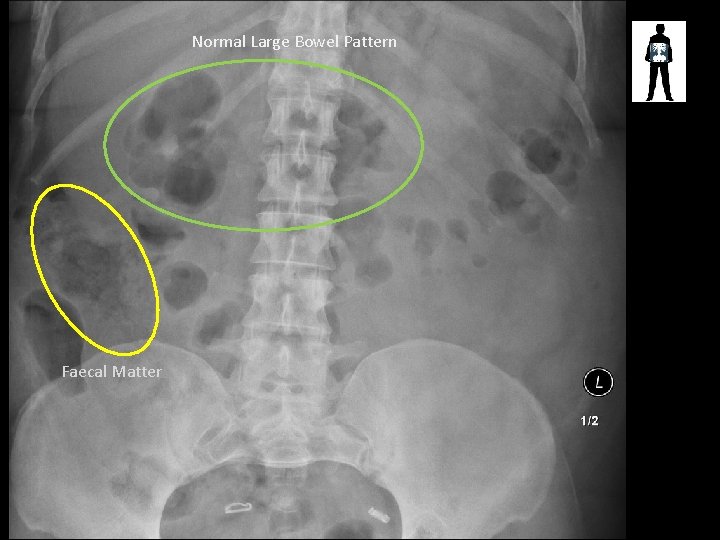 Normal Large Bowel Pattern Faecal Matter 
